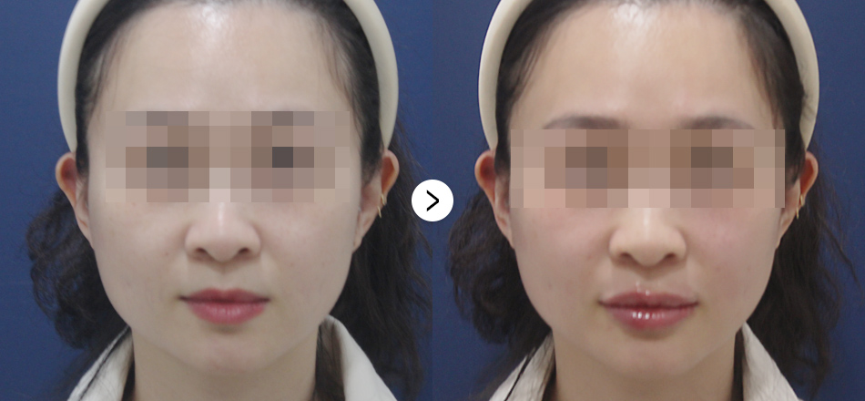 케이톡스 전후사진