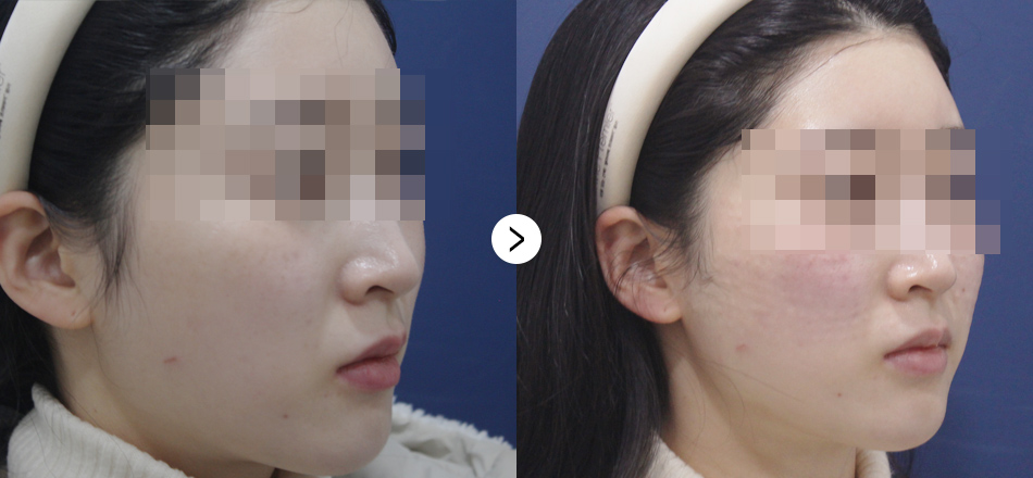 케이톡스 전후사진