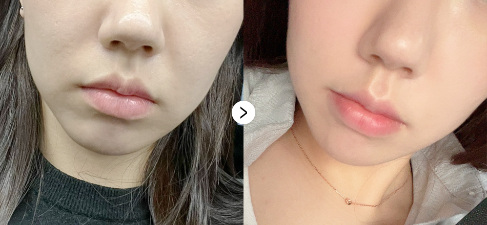 케이톡스 전후사진