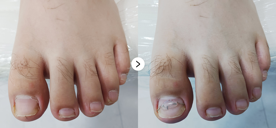 케이톡스 전후사진