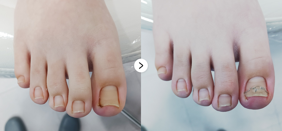 케이톡스 전후사진