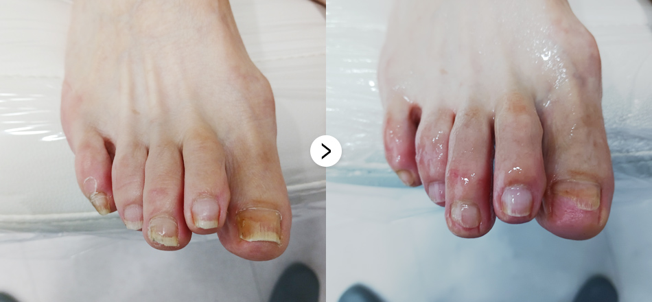 케이톡스 전후사진