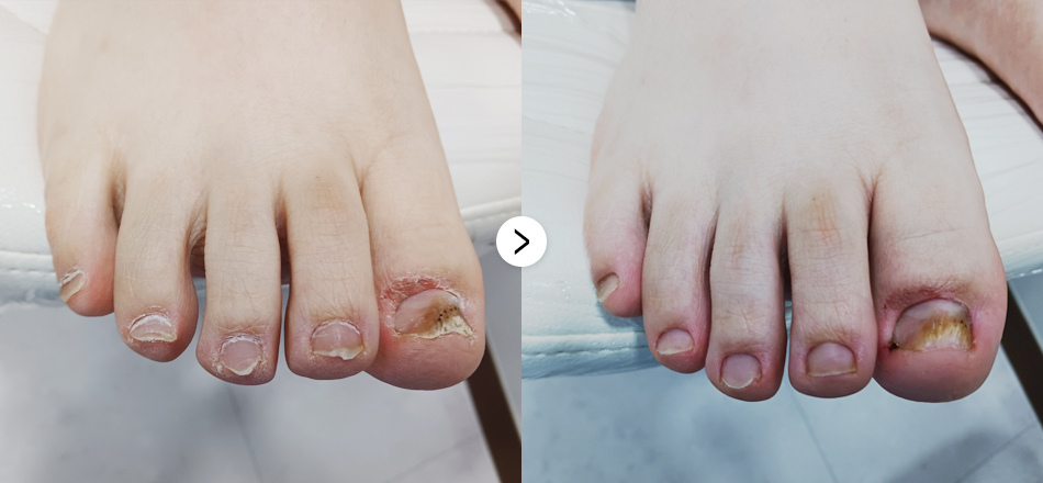 케이톡스 전후사진