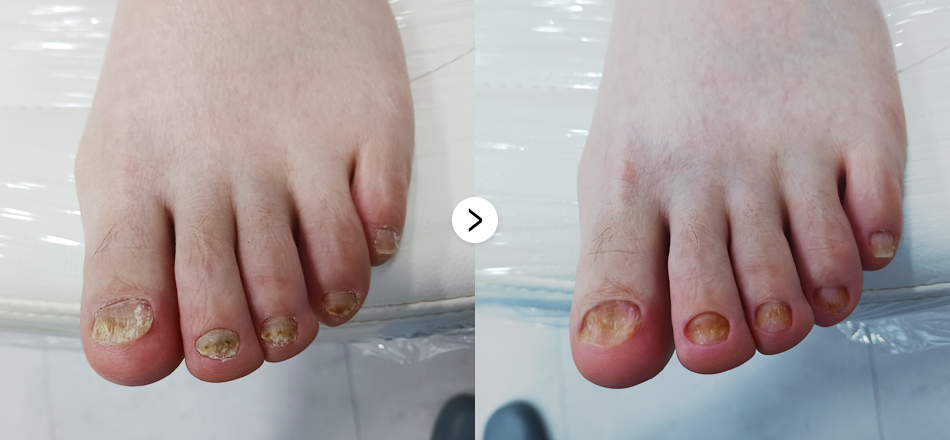 케이톡스 전후사진