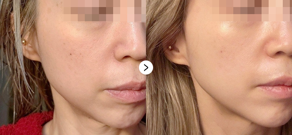 케이톡스 전후사진