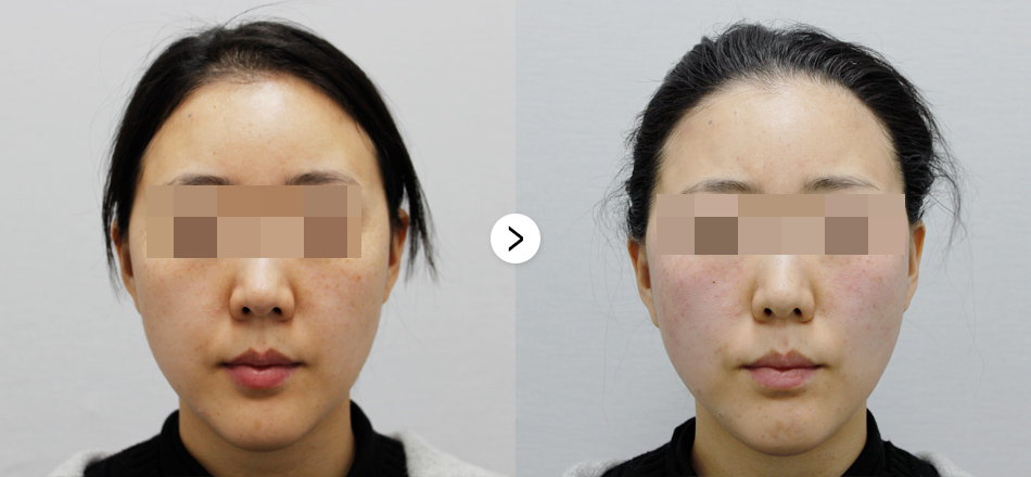 케이톡스 전후사진