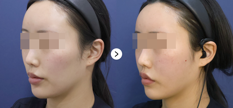 케이톡스 전후사진