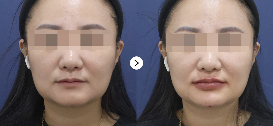 케이톡스 전후사진