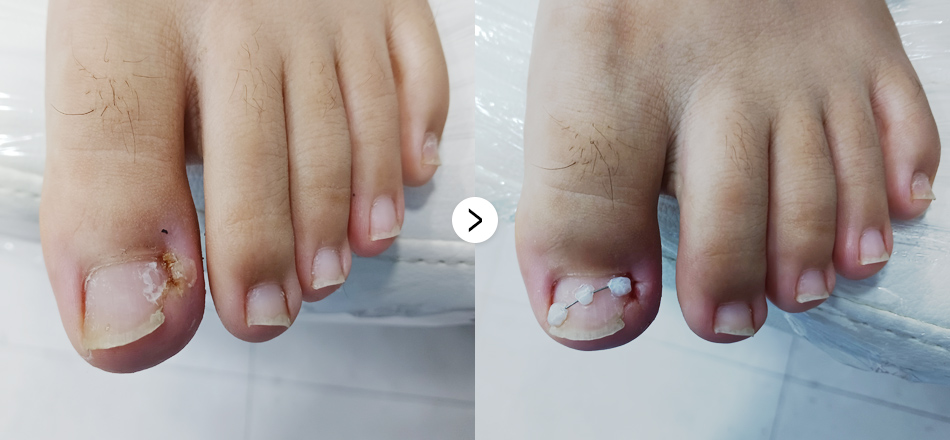 케이톡스 전후사진