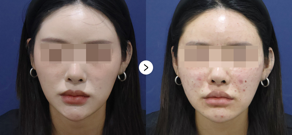 케이톡스 전후사진