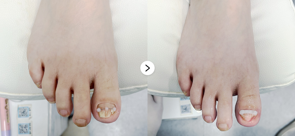 케이톡스 전후사진